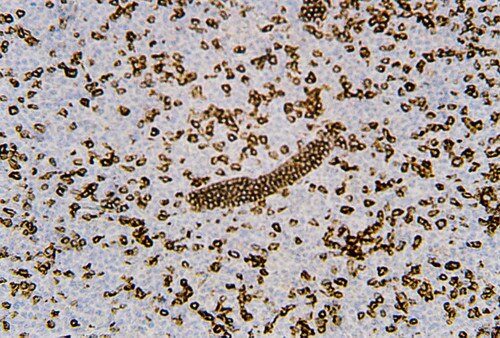 IHC of CD5 on an FFPE Non-Hodgkin’s Lymphoma Tissue